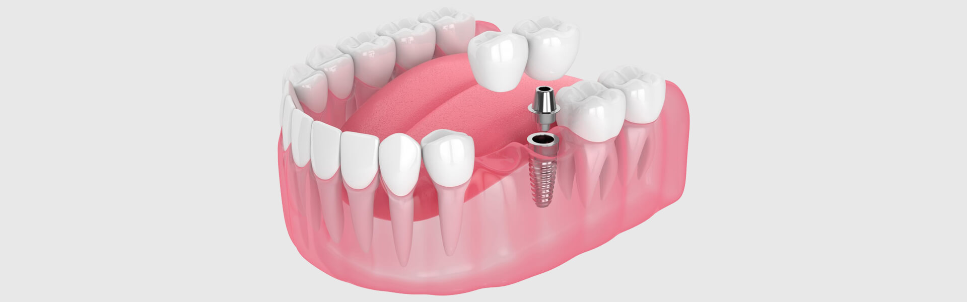 All-on-X implants