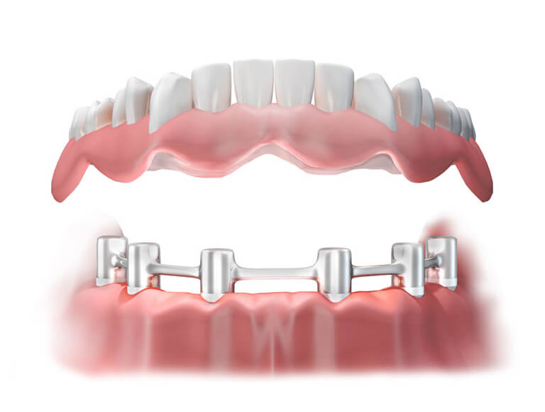 Benefits of Implant-Supported Dentures